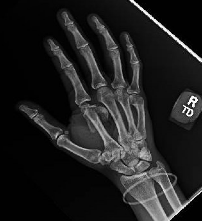 Metacarpal Head Fracture X-ray